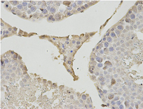 Immunohistochemical analysis of formalin fixed and paraffin embedded human breast cancer tissue labeling Proteasome beta 1 with ab196623 at a 1/200 dilution.