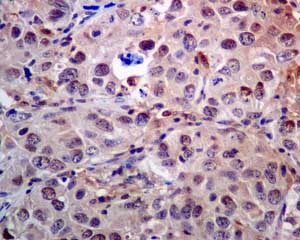 Immunohistochemical analysis of paraffin-embedded breast carcinoma tissue labelling Proteasome subunit beta type 2 with ab137108 at 1/50 dilution.