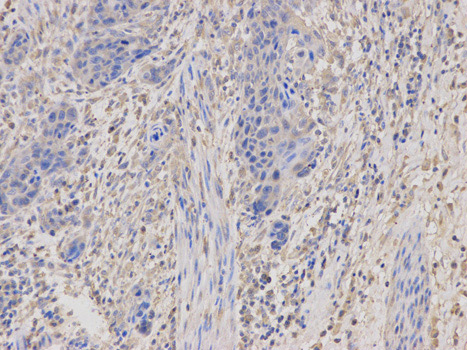 Immunohistochemistry (Formalin/PFA-fixed paraffin-embedded sections) analysis of human esophageal cancer tissue labelling Protein Kinase A regulatory subunit I alpha with ab180825 at 1/100. Magnification: 200x.