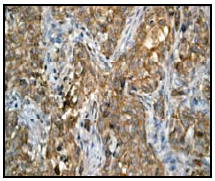 Ab51250 (1:100) staining human Protein Kinase D2 in human breast carcinoma tissue by immunohistochemistry using paraffin embedded tissue.Ab51250 (1:100) staining human Protein Kinase D2 in human breast carcinoma tissue by immunohistochemistry using paraffin embedded tissue.