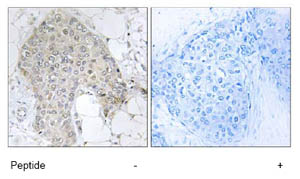 Immunohistochemistry analysis of paraffin-embedded human breast carcinoma tissue using ab73948, at 1/50 dilution, in the presence (right panel) or absence (left panel) of immunising peptide.