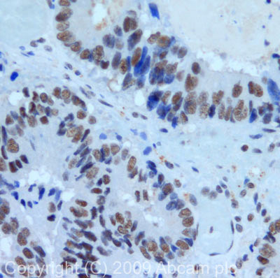IHC image of PRPF8 staining in human colon carcinoma formalin fixed paraffin embedded tissue section, performed on a Leica BondTM system using the standard protocol F. The section was pre-treated using heat mediated antigen retrieval with sodium citrate buffer (pH6, epitope retrieval solution 1) for 20 mins. The section was then incubated with ab79237, 10µg/ml, for 15 mins at room temperature and detected using an HRP conjugated compact polymer system. DAB was used as the chromogen. The section was then counterstained with haematoxylin and mounted with DPX.