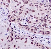Immunohistochemical analysis of paraffin embedded Human cervix carcinoma tissue sections labeling PRPF8 using ab185547 at a 1/250 dilution. A ready to use HRP Polymer for Rabbit IgG was used as the secondary. Hematoxylin counterstain.