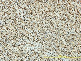 PRPK antibody (ab57700) used in immunohistochemistry at 2ug/ml on formalin fixed and paraffin embedded human lymphoma tissue.