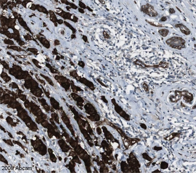 Image courtesy of Human Protein Atlas . ab34173 staining NQO1 in human breast cancer. Paraffin embedded human breast cancer tissue was incubated with ab34173 (1/200 dilution) for 30 mins at room temperature. Antigen retrieval was performed by heat induction in citrate buffer pH 6. ab34173 was tested in a tissue microarray (TMA) containing a wide range of normal and cancer tissues. Further results for this antibody can be found at www.proteinatlas.org