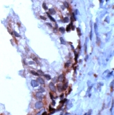 ab15169 staining PSCA in human breast carcinoma by Immunohistochemistry (Formalin/ PFA fixed paraffin embedded tissue sections).
