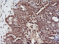 ab119869, at 1/150, staining PSMA4 in paraffin embedded adenocarcinoma of Human ovary tissue by Immunohistochemistry.