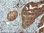 ab119849 at 1/150, staining PSMA4 in paraffin-embedded Human endometrium adenocarcinoma tissue by Immunohistochemistry.