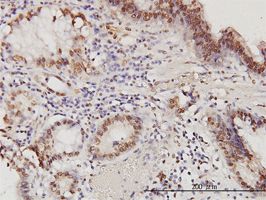 PSME2 antibody (ab58123) used in immunohistochemistry at 6ug/ml on formalin fixed and paraffin embedded human stomach carcinoma.