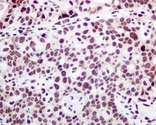 Immunohistochemical analysis of PTBP1 in paraffin embedded Human breast carcinoma tissue stained with ab133734 at a 1/100 dilution.
