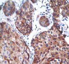 ab76239, at a 1/50 dilution, staining human PTP1B (phospho S378) in breast carcinoma by Immunohistochemistry, Formalin/PFA-fixed paraffin-embedded tissue.