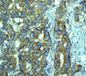 ab33906 at a 1:100 dilution staining PUMA in human breast carcinoma using Immunohistochemistry, Paraffin Embedded Tissue.