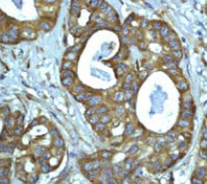 ab33906 at a 1:100 dilution staining PUMA in human ovary carcinoma using Immunohistochemistry, Paraffin Embedded Tissue.
