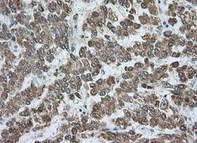ab118998, at 1/50 dilution, staining Rab17 in paraffin embedded Human liver carcinoma tissue by Immunohistochemistry.