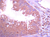 Immunohistochemistry analysis of paraffin-embedded Human tubular colorectal carcinoma using ab78139 at 1/1000 dilution with an HRP-DAB detection system. Tissue pretreated with citrate pH6.0 antigen retrieval. Immunoreactivity is seen primarily as diffusive plasma membrane staining.