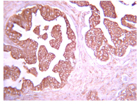 Immunohistochemistry analysis of paraffin-embedded Human prostate carcinoma using ab78139 at 1/1000 dilution with an HRP-DAB detection system. Tissue pretreated with citrate pH6.0 antigen retrieval. Immunoreactivity is seen primarily as diffusive plasma membrane staining with some stromal background staining.