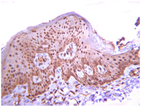 Immunohistochemistry analysis of paraffin-embedded Human squamous cells carcinoma using ab78139 at 1/1000 dilution with an HRP-DAB detection system. Tissue pretreated with citrate pH6.0 antigen retrieval. Immunoreactivity is seen primarily as diffusive nuclear staining pattern.