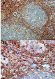 Ab2244 (0.3µg/ml) staining of paraffin embedded Human Tonsil. Microwaved antigen retrieval with Tris/EDTA buffer pH9, HRP-staining. A) Strong staining in the interfollicular area and mantle zone but the majority of cells in germinal centre are negative. B) Higher magnification of interfollicular area showing positive cells.