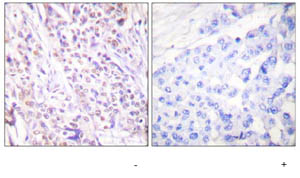 1/50 ab63509, staining Rad17 on human breast carcinoma tissue, in the absence (left) and presence (right) of the immunizing peptide
