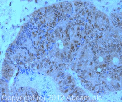 IHC image of ab31917 staining in human colon carcinoma formalin fixed paraffin embedded tissue section, performed on a Leica BondTM system using the standard protocol F. The section was pre-treated using heat mediated antigen retrieval with sodium citrate buffer (pH6, epitope retrieval solution 1) for 20 mins. The section was then incubated with ab31917, 1µg/ml, for 15 mins at room temperature and detected using an HRP conjugated compact polymer system. DAB was used as the chromogen. The section was then counterstained with haematoxylin and mounted with DPX. For other IHC staining systems (automated and non-automated) customers should optimize variable parameters such as antigen retrieval conditions, primary antibody concentration and antibody incubation times.