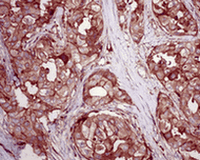 ab126627, at 1/100, staining RALA in formalin fixed, paraffin embedded Human breast carcinoma tissue by Immunohistochemistry.