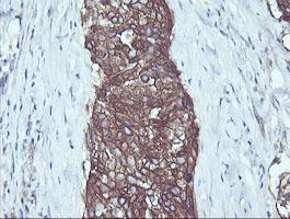 Immunohistochemical analysis of paraffin-embedded Human lung carcinoma tissue, labeling RALB using ab156799 at 1/150 dilution.