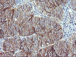 Immunohistochemical analysis of paraffin-embedded Human ovary adenocarcinoma tissue, labeling RALB using ab156799 at a 1/150 dilution.