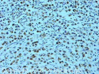 IHC image of ab56815 staining in human breast cancer formalin fixed paraffin embedded tissue section, performed on a Leica BondTM system using the standard protocol F. The section was pre-treated using heat mediated antigen retrieval with sodium citrate buffer (pH6, epitope retrieval solution 1) for 20 mins. The section was then incubated with ab56815, 1µg/ml, for 15 mins at room temperature and detected using an HRP conjugated compact polymer system. DAB was used as the chromogen. The section was then counterstained with haematoxylin and mounted with DPX.For other IHC staining systems (automated and non-automated) customers should optimize variable parameters such as antigen retrieval conditions, primary antibody concentration and antibody incubation times.