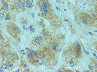 IHC image of RALGDS staining in Human Liver Cancer FFPE section, performed on a BondTM system using the standard protocol F. The section was pre-treated using heat mediated antigen retrieval with sodium citrate buffer (pH6, epitope retrieval solution 1) for 20 mins. The section was then incubated with ab65204, 5µg/ml, for 15 mins at room temperature and detected using an HRP conjugated compact polymer system. DAB was used as the chromogen. The section was then counterstained with haematoxylin and mounted with DPX