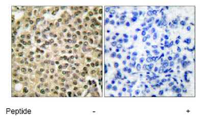 Immunohistochemical analysis of paraffin-embedded human breast carcinoma tissue using ab53775 at a 1/50 dilution.Left image un-treated.Right image treated with immunizing peptide.