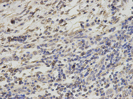 Immunohistochemistry (Formalin/PFA-fixed paraffin-embedded sections) analysis of human liver cancer tissue labelling RanGAP1 with ab186849 at 1/200. Magnification: 400x.