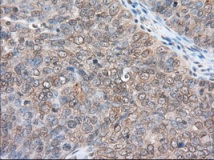 ab119092 at 1/50 dilution staining RanGAP1 in paraffin-embedded Human ovary adenocarcinoma tissue by Immunohistochemistry.