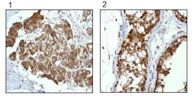 b92360 at 1/100 dilution staining RanGAP1 in paraffin-embedded (1) Human breast carcinoma tissue and (2) Human testis tissue by immunohistochemistry.