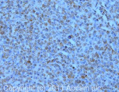 IHC image of ab13918 staining in human t cell lymphoma formalin fixed paraffin embedded tissue section, performed on a Leica BondTM system using the standard protocol F. The section was pre-treated using heat mediated antigen retrieval with sodium citrate buffer (pH6, epitope retrieval solution 1) for 20 mins. The section was then incubated with ab13918, 5µg/ml, for 15 mins at room temperature and detected using an HRP conjugated compact polymer system. DAB was used as the chromogen. The section was then counterstained with haematoxylin and mounted with DPX. For other IHC staining systems (automated and non-automated) customers should optimize variable parameters such as antigen retrieval conditions, primary antibody concentration and antibody incubation times.