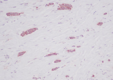 ab9679 staining RANTES in human breast invasive ductal carcinoma tissue section by Immunohistochemistry (Formalin/PFA fixed paraffin-embedded sections). Tissue underwent heat mediated antigen retrieval in sodium citrate buffer (pH 6.0). The primary antibody was used at 2.0 ug/ml and incubated with sample at 4°C overnight. A HRP-labeled polymer detection system was used with an AEC chromogen.