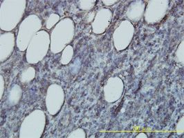 RAP2B antibody (ab58109) used in immunohistochemistry at 1ug/ml on formalin fixed and paraffin embedded human malignant lymphoma, diffuse large B tissue.