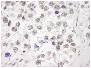 ab114855, at 1/250 dilution, staining RAP80 in formalin-fixed, paraffin-embedded Human seminoma tissue by Immunohistochemistry with DAB staining.