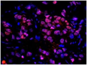 ab114855, at 1/100 dilution, staining RAP80 in formalin-fixed, paraffin-embedded Human breast carcinoma tissue by Immunohistochemistry. Detection: Red-fluorescent goat anti-rabbit IgG highly cross-adsorbed antibody Hilyte PlusTM 555 at 1/100 dilution.