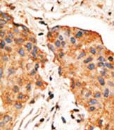 ab80237, at a 1/50 dilution, staining NRG1 in formalin fixed, paraffin embedded human breast carcinoma tissue by Immunohistochemistry. Peroxidase conjugated secondary antibody was used, followed by DAB staining.