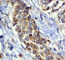 ab40807 at a 1:100 dilution staining RASA1 in Human breast carcinoma tissue.