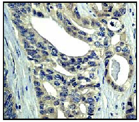 Immunohistochemical analysis of paraffin embedded human ovary carcinoma using ab40677 diluted 1:50.Immunohistochemical analysis of paraffin embedded human ovary carcinoma using ab40677 diluted 1:50.