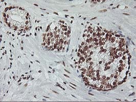 ab119423 at 1/150 dilution staining RASSF1 in Paraffin-embedded Human Prostate carcinoma tissue by Immunohistochemistry.