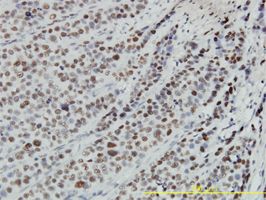 RbAp48 antibody (ab55778) used in immunohistochemistry at 3ug/ml on formalin fixed and paraffin embedded human transitional cell carcinoma tissue.