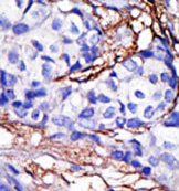 Formalin-fixed and paraffin-embedded human breast cancer tissue reacted with ab38540 at a 1/50 dilution, which was peroxidase-conjugated to the secondary antibody, followed by AEC staining. This data demonstrates the use of this antibody for immunohistochemistry; clinical relevance has not been evaluated. 