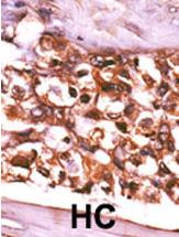 ab71451, at a 1/50 dilution, staining human RBKS in hepatocarcinoma, using Immunohistochemistry, Formalin/PFA fixed Paraffin embedded tissue.