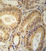 Immunohistochemical analysis of formalin-fixed paraffin-embedded Human prostate carcinoma tissue labeling RBM24 using ab174919 at 1/50 dilution, followed by peroxidase conjugation of the secondary antibody and DAB staining.