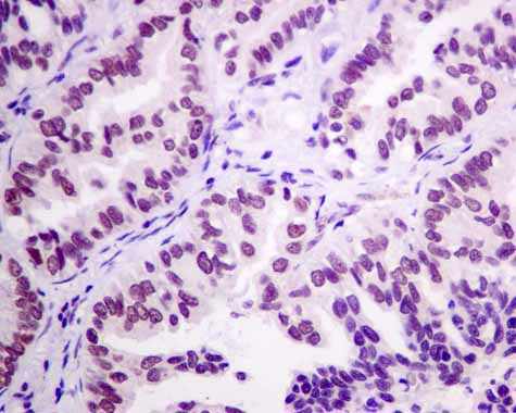 ab167164 showing +ve staining in Human lung carcinoma.