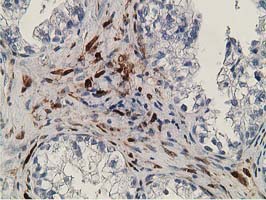 ab119056, at 1/150 dilution, staining RBP1 in paraffin-embedded Human ovary adenocarcinoma tissue by Immunohistochemistry.