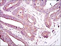 ab114062, at a 1/200 dilution, staining RBP4 in paraffin embedded Human stomach cancer tissue by Immunohistochemistry, with DAB staining.