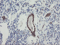 ab128081 at 1/150 dilution staining RBPMS in Paraffin-embedded Human kidney carcinoma tissue by Immunohistochemistry.